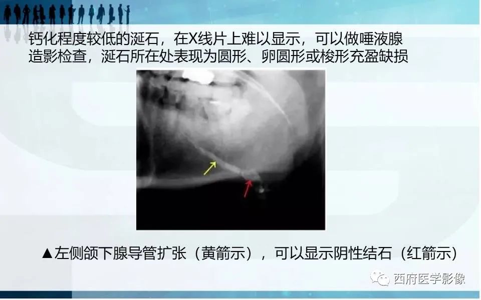 影像PPT - 【PPT】涎石症的影像诊断-25