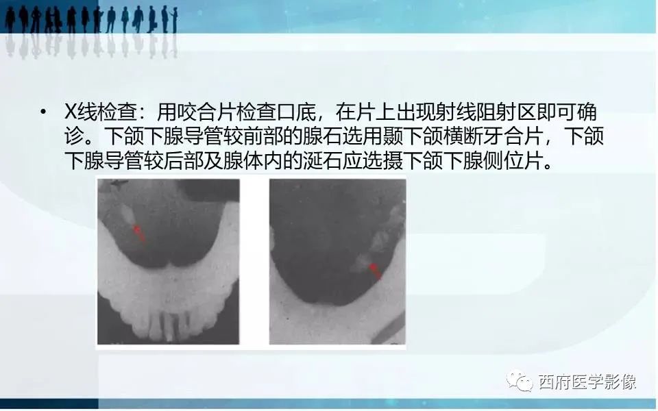 影像PPT - 【PPT】涎石症的影像诊断-23