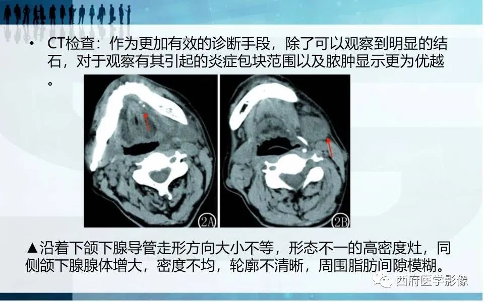 影像PPT - 【PPT】涎石症的影像诊断-26
