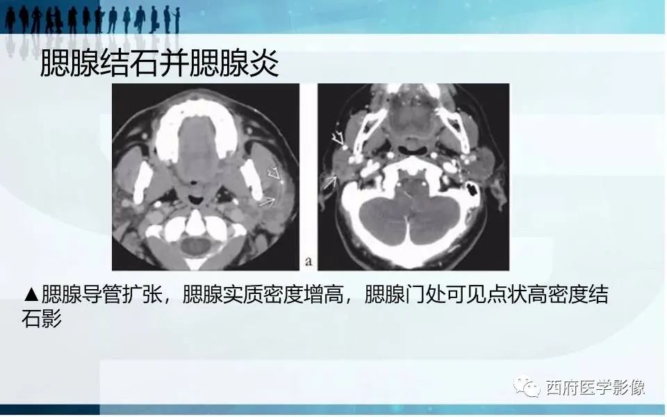 影像PPT - 【PPT】涎石症的影像诊断-27