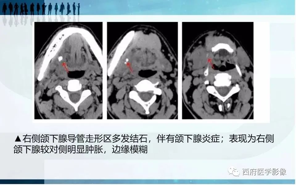 影像PPT - 【PPT】涎石症的影像诊断-29