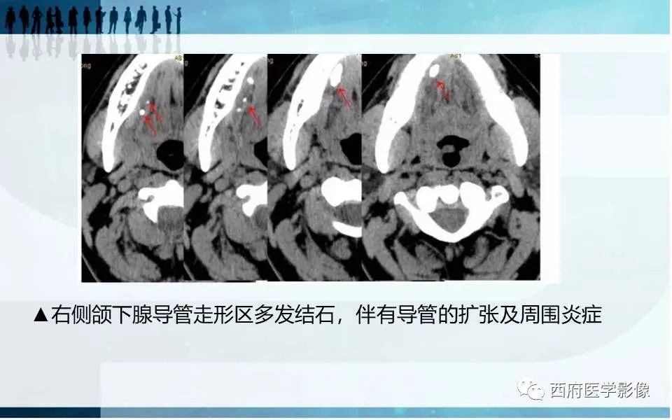 影像PPT - 【PPT】涎石症的影像诊断-28