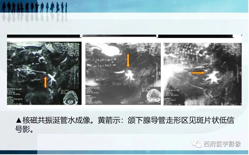 影像PPT - 【PPT】涎石症的影像诊断-31