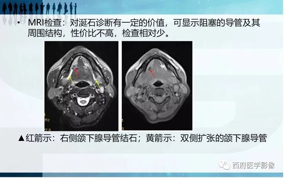 影像PPT - 【PPT】涎石症的影像诊断-30