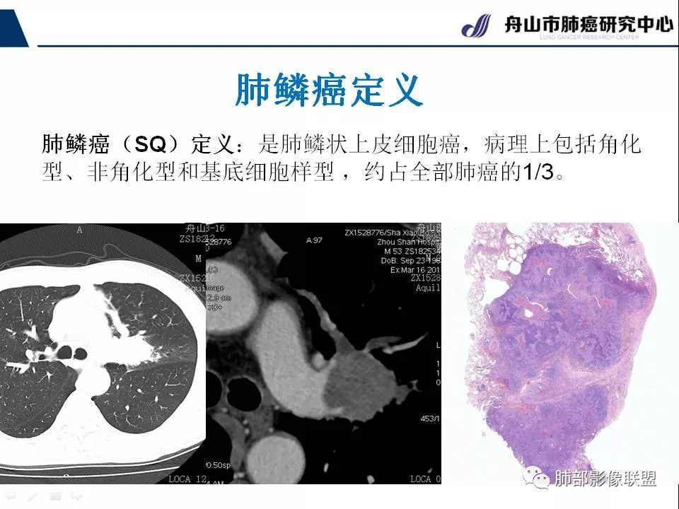 影像PPT - 【PPT】早期肺鳞癌----容易忽视的影像学表现-2