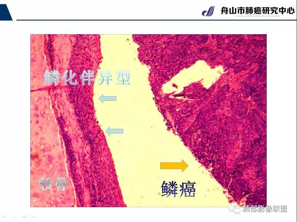 影像PPT - 【PPT】早期肺鳞癌----容易忽视的影像学表现-8