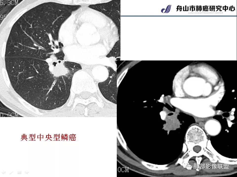影像PPT - 【PPT】早期肺鳞癌----容易忽视的影像学表现-11