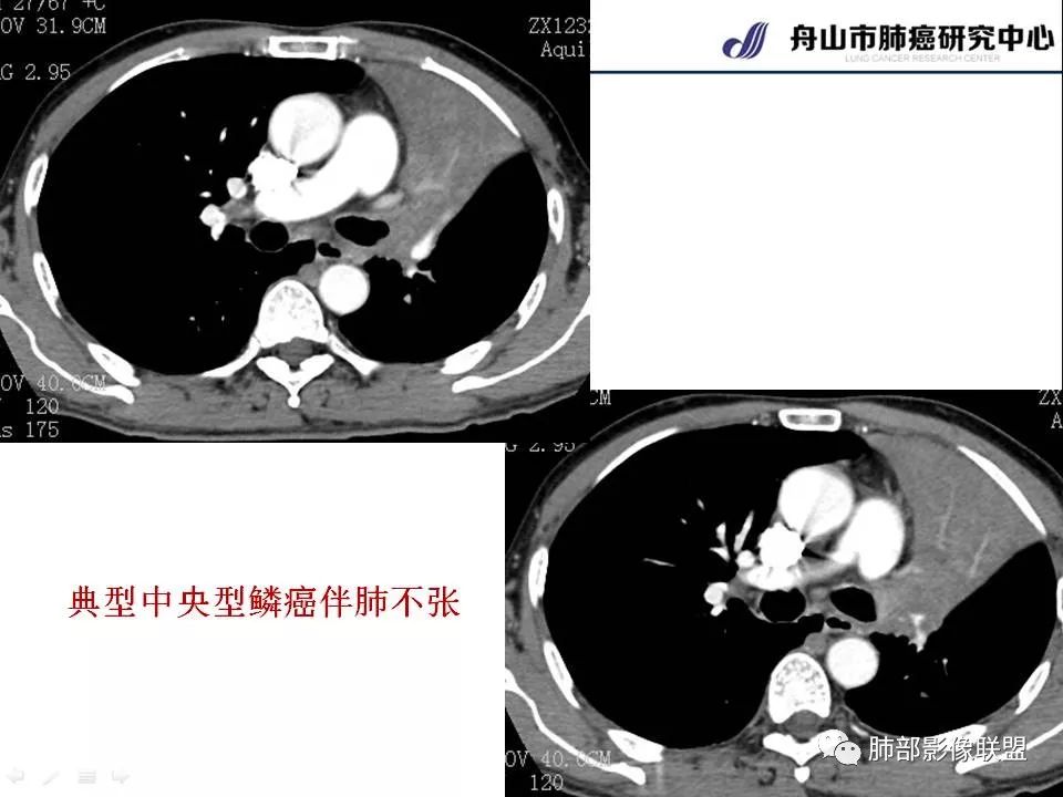 影像PPT - 【PPT】早期肺鳞癌----容易忽视的影像学表现-12