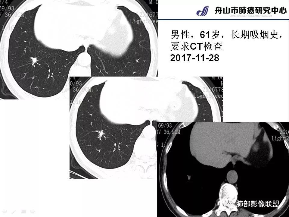 影像PPT - 【PPT】早期肺鳞癌----容易忽视的影像学表现-14