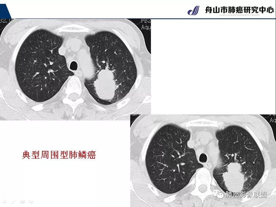 影像PPT - 【PPT】早期肺鳞癌----容易忽视的影像学表现-13