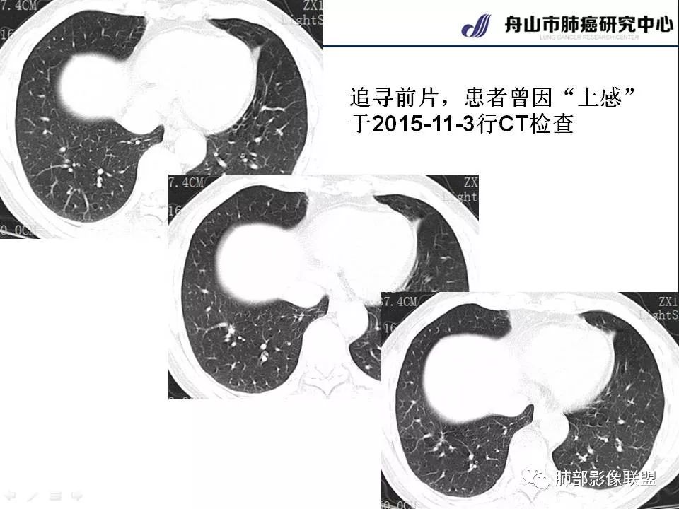 影像PPT - 【PPT】早期肺鳞癌----容易忽视的影像学表现-15