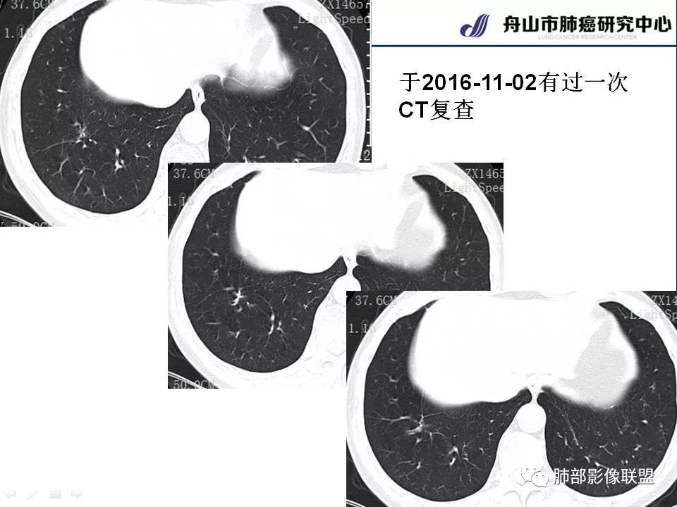 影像PPT - 【PPT】早期肺鳞癌----容易忽视的影像学表现-16