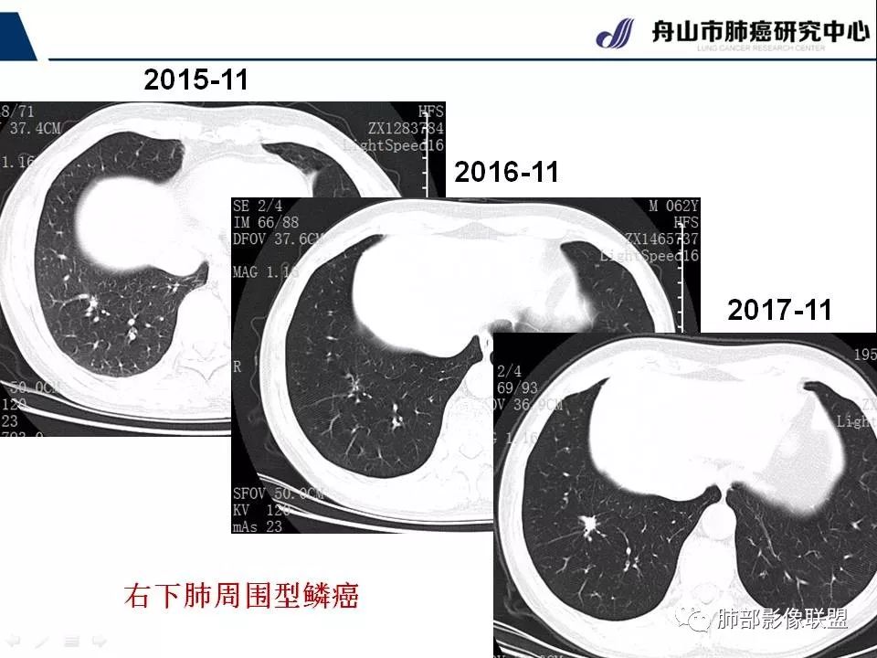 影像PPT - 【PPT】早期肺鳞癌----容易忽视的影像学表现-17