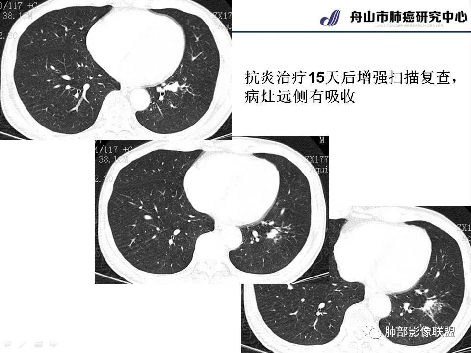 影像PPT - 【PPT】早期肺鳞癌----容易忽视的影像学表现-20