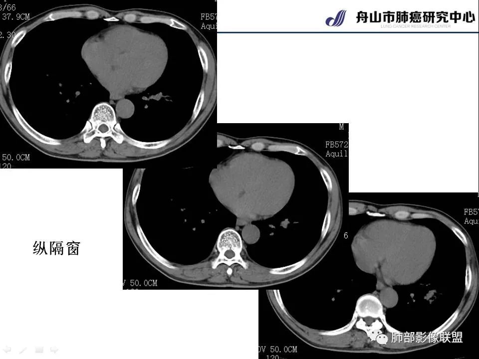 影像PPT - 【PPT】早期肺鳞癌----容易忽视的影像学表现-19