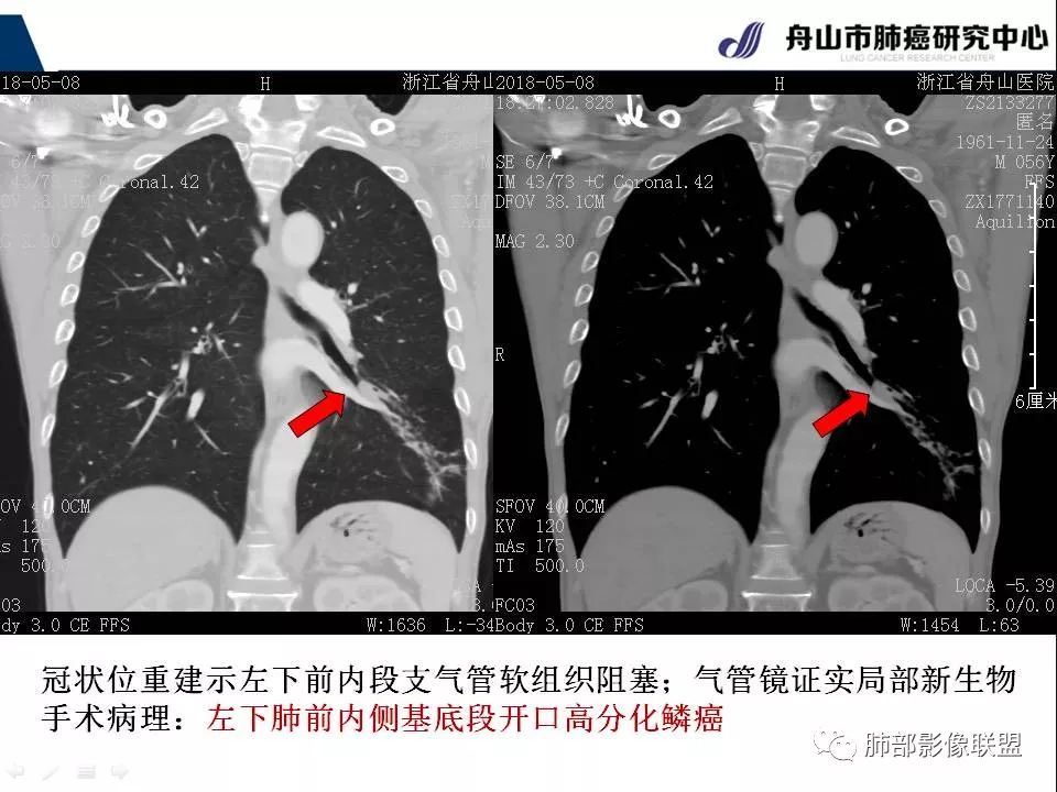 影像PPT - 【PPT】早期肺鳞癌----容易忽视的影像学表现-22
