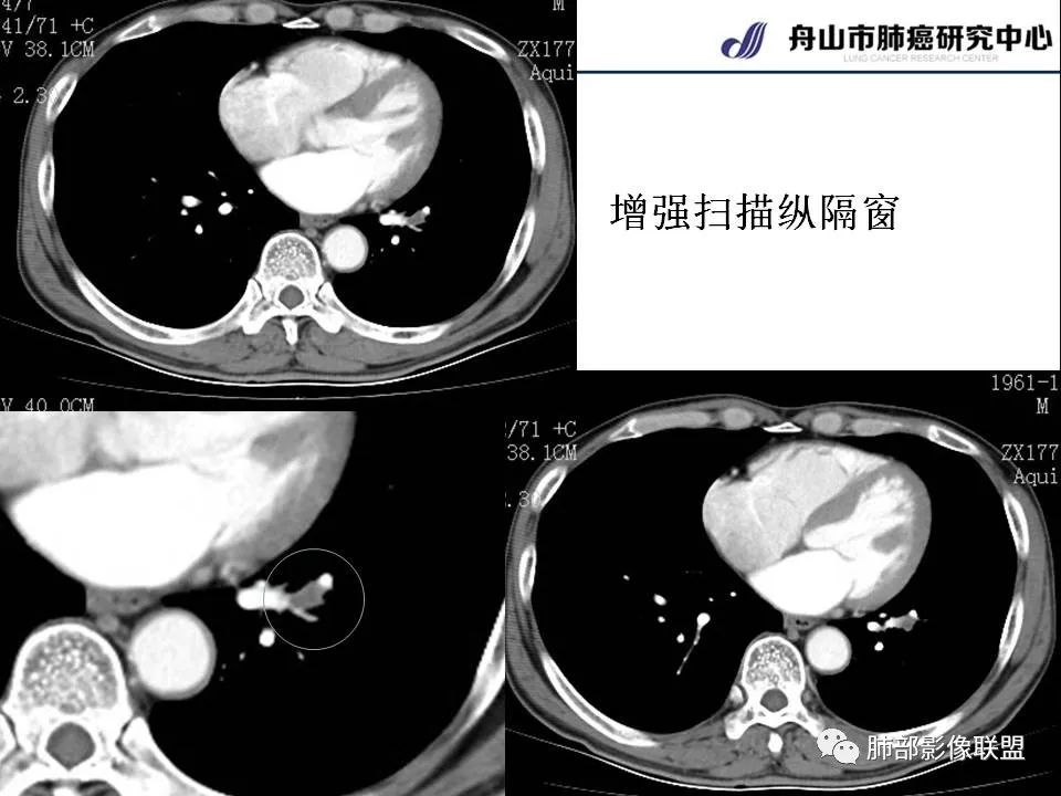 影像PPT - 【PPT】早期肺鳞癌----容易忽视的影像学表现-21