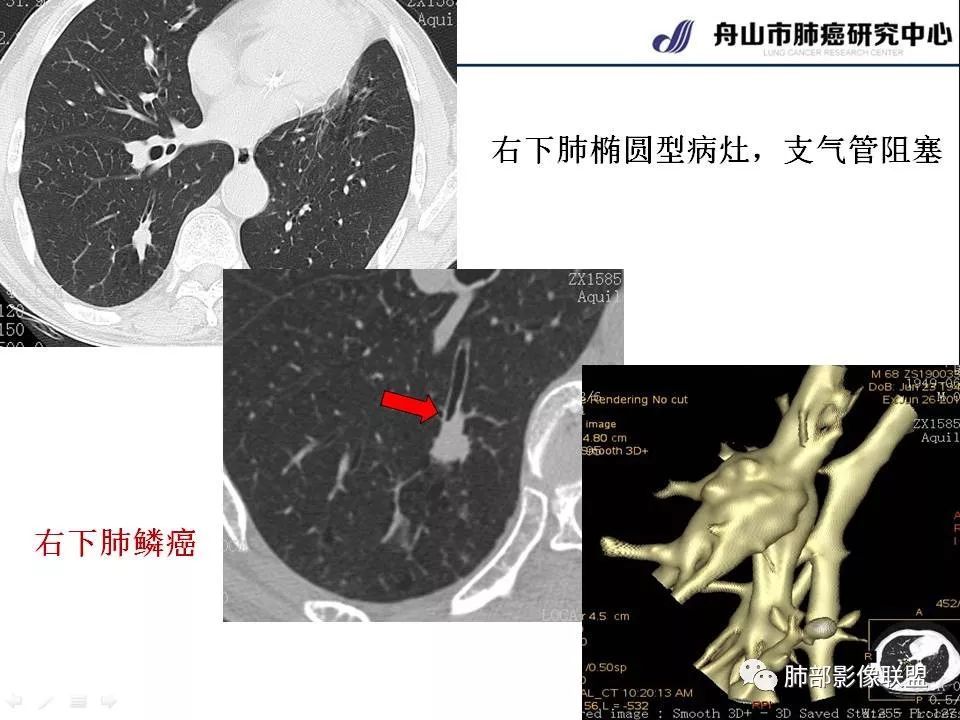 影像PPT - 【PPT】早期肺鳞癌----容易忽视的影像学表现-24