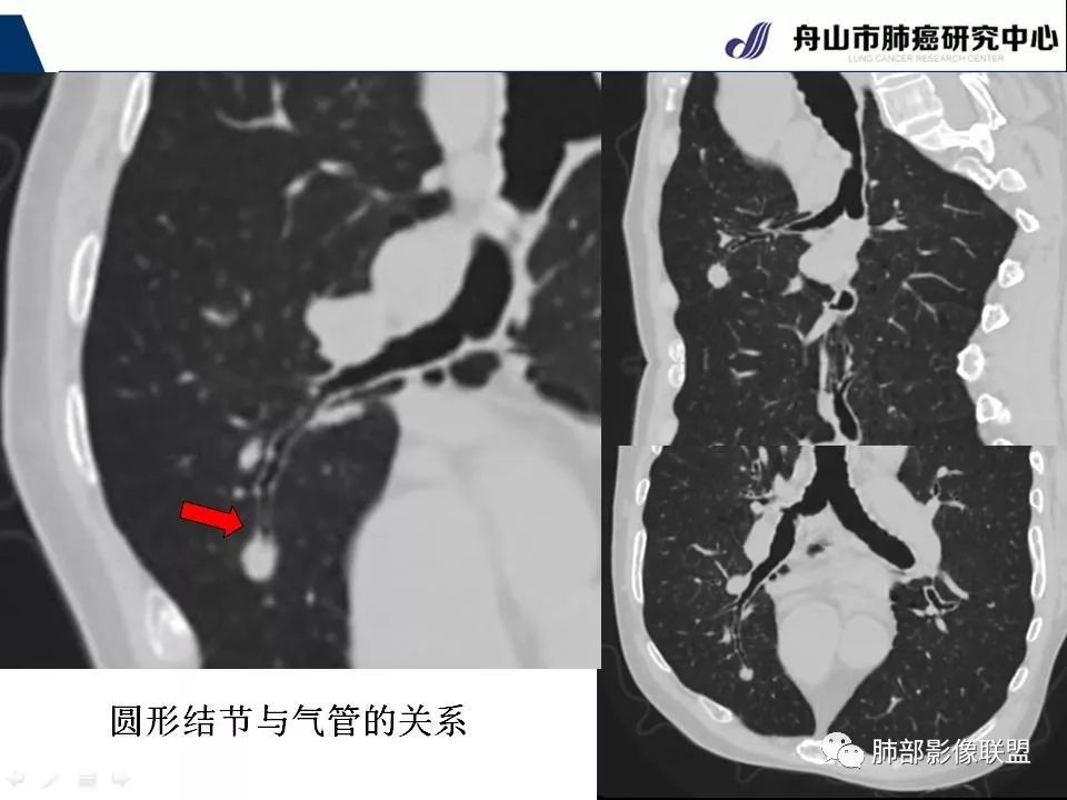 影像PPT - 【PPT】早期肺鳞癌----容易忽视的影像学表现-28