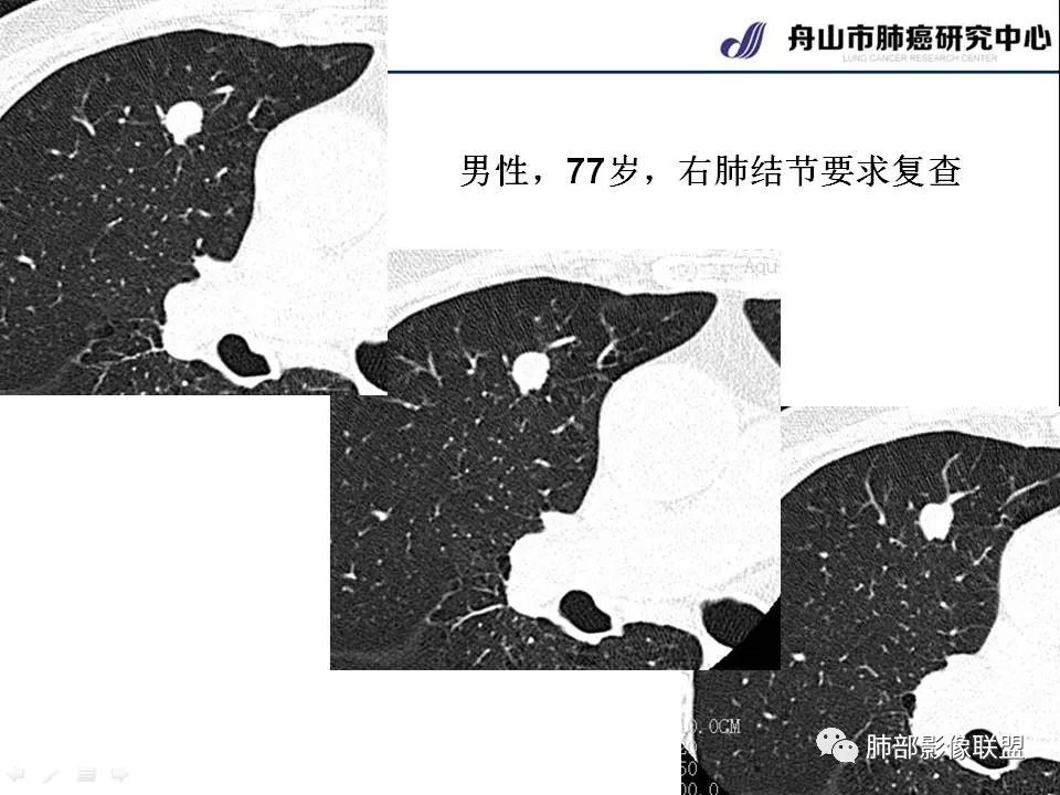 影像PPT - 【PPT】早期肺鳞癌----容易忽视的影像学表现-27