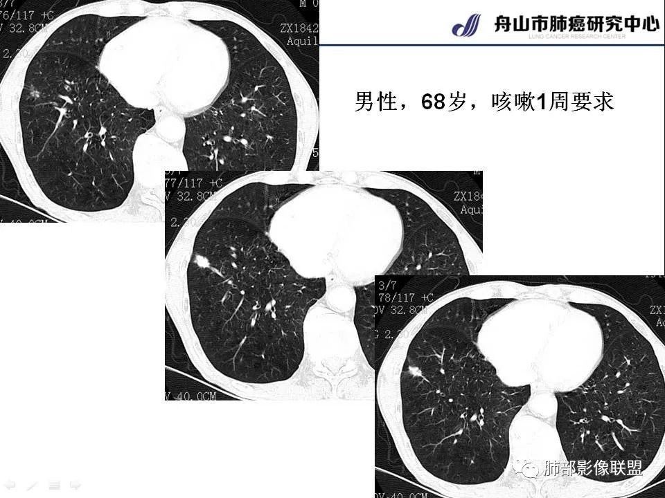 影像PPT - 【PPT】早期肺鳞癌----容易忽视的影像学表现-25