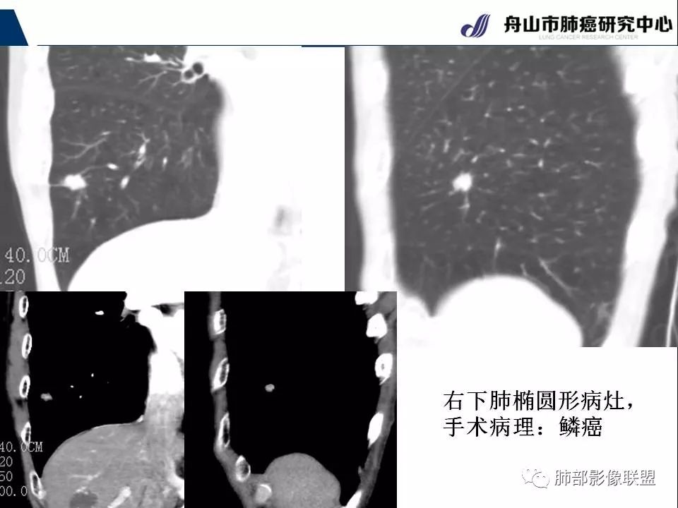 影像PPT - 【PPT】早期肺鳞癌----容易忽视的影像学表现-26