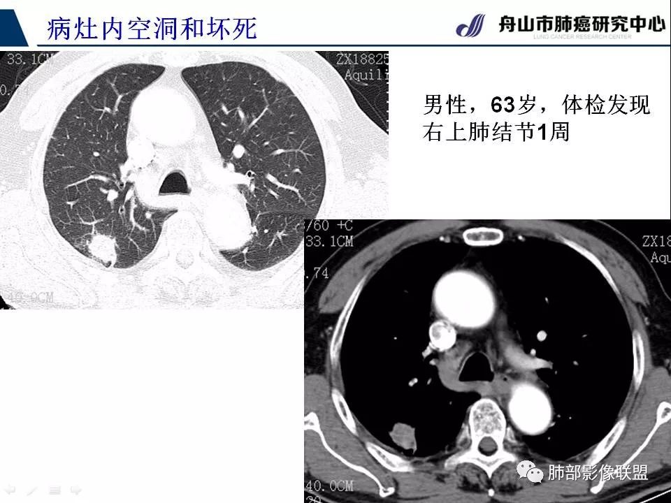 影像PPT - 【PPT】早期肺鳞癌----容易忽视的影像学表现-30