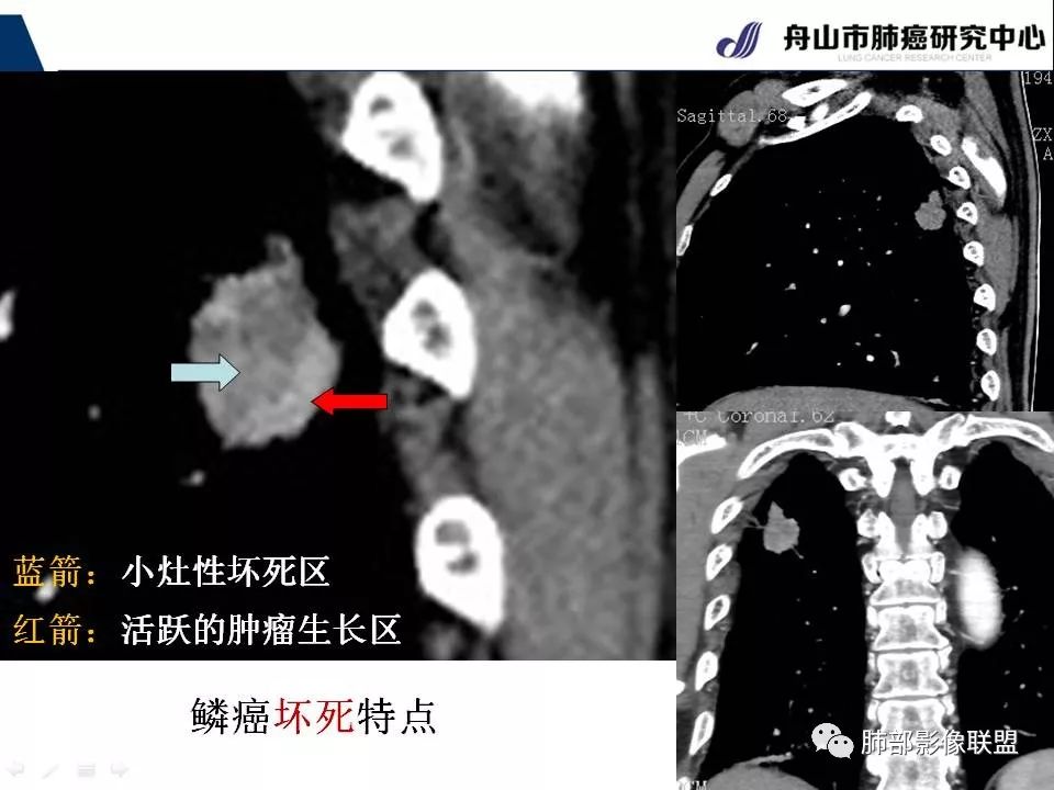 影像PPT - 【PPT】早期肺鳞癌----容易忽视的影像学表现-31