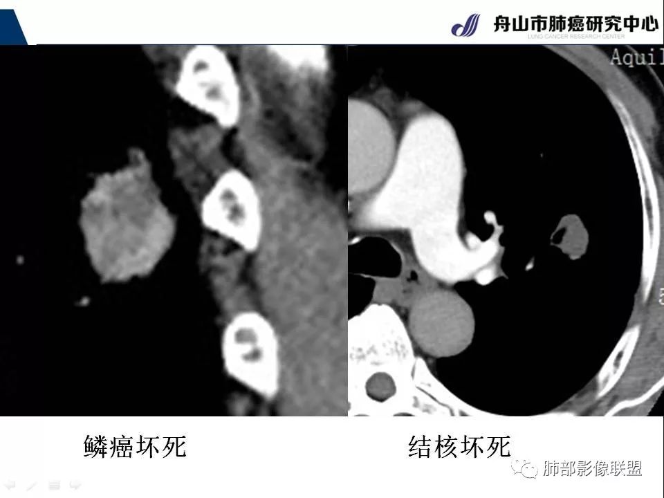 影像PPT - 【PPT】早期肺鳞癌----容易忽视的影像学表现-32