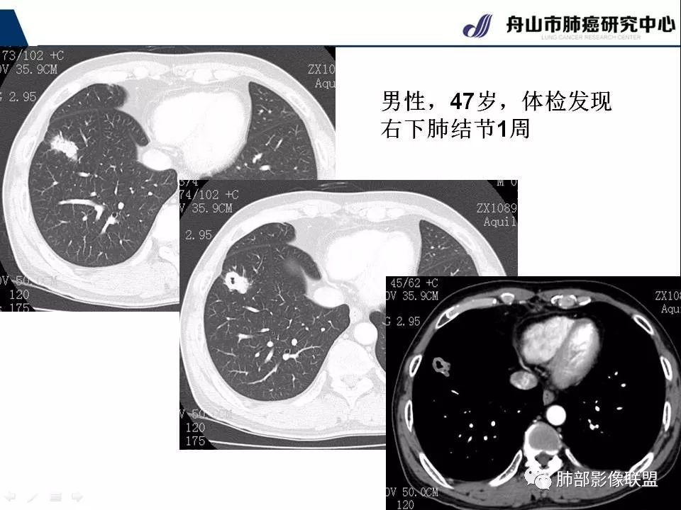 影像PPT - 【PPT】早期肺鳞癌----容易忽视的影像学表现-34