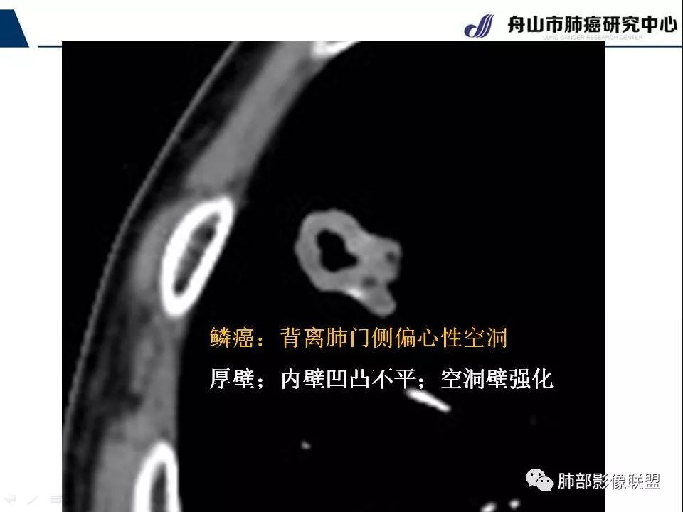 影像PPT - 【PPT】早期肺鳞癌----容易忽视的影像学表现-35