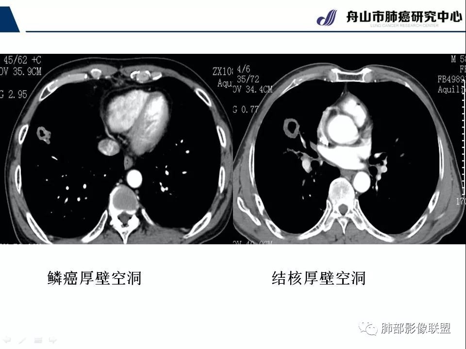 影像PPT - 【PPT】早期肺鳞癌----容易忽视的影像学表现-36