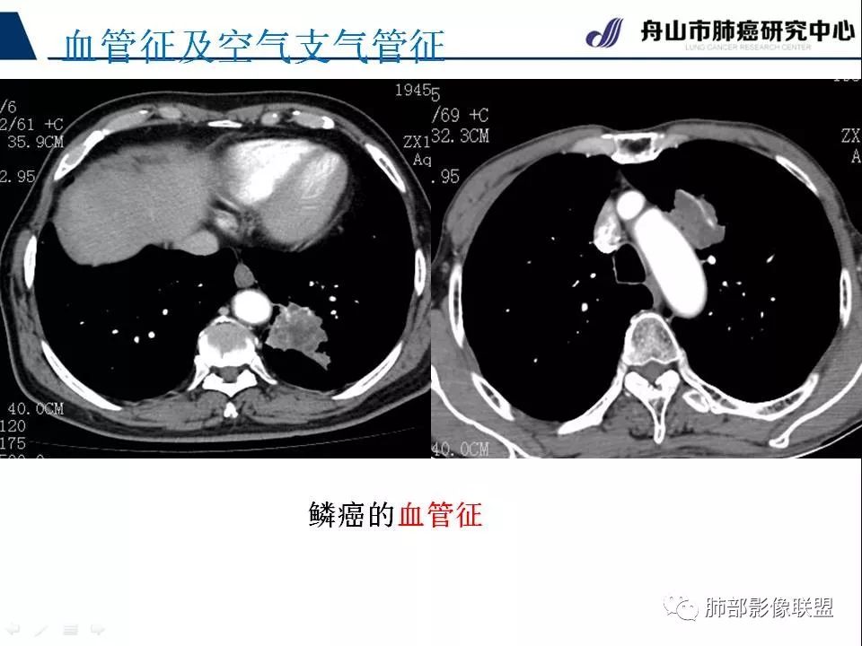 影像PPT - 【PPT】早期肺鳞癌----容易忽视的影像学表现-38