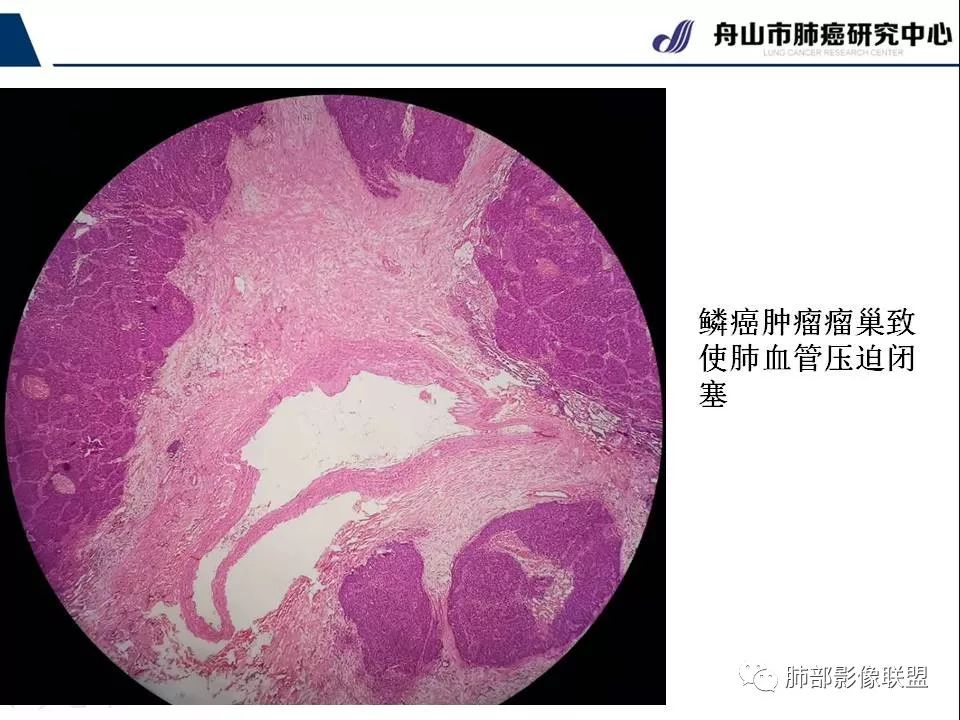 影像PPT - 【PPT】早期肺鳞癌----容易忽视的影像学表现-39