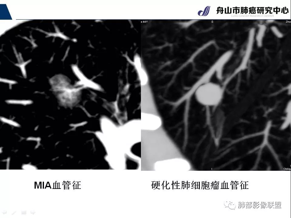 影像PPT - 【PPT】早期肺鳞癌----容易忽视的影像学表现-41