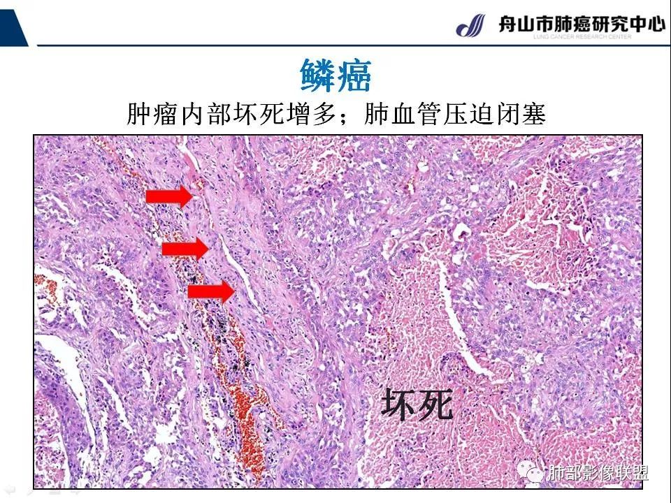 影像PPT - 【PPT】早期肺鳞癌----容易忽视的影像学表现-40