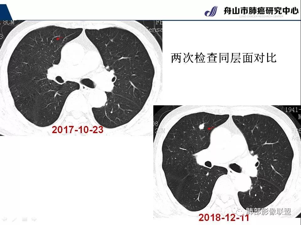 影像PPT - 【PPT】早期肺鳞癌----容易忽视的影像学表现-49