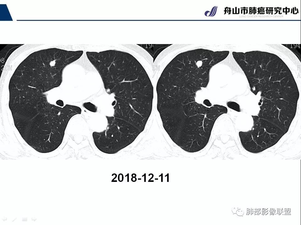 影像PPT - 【PPT】早期肺鳞癌----容易忽视的影像学表现-48