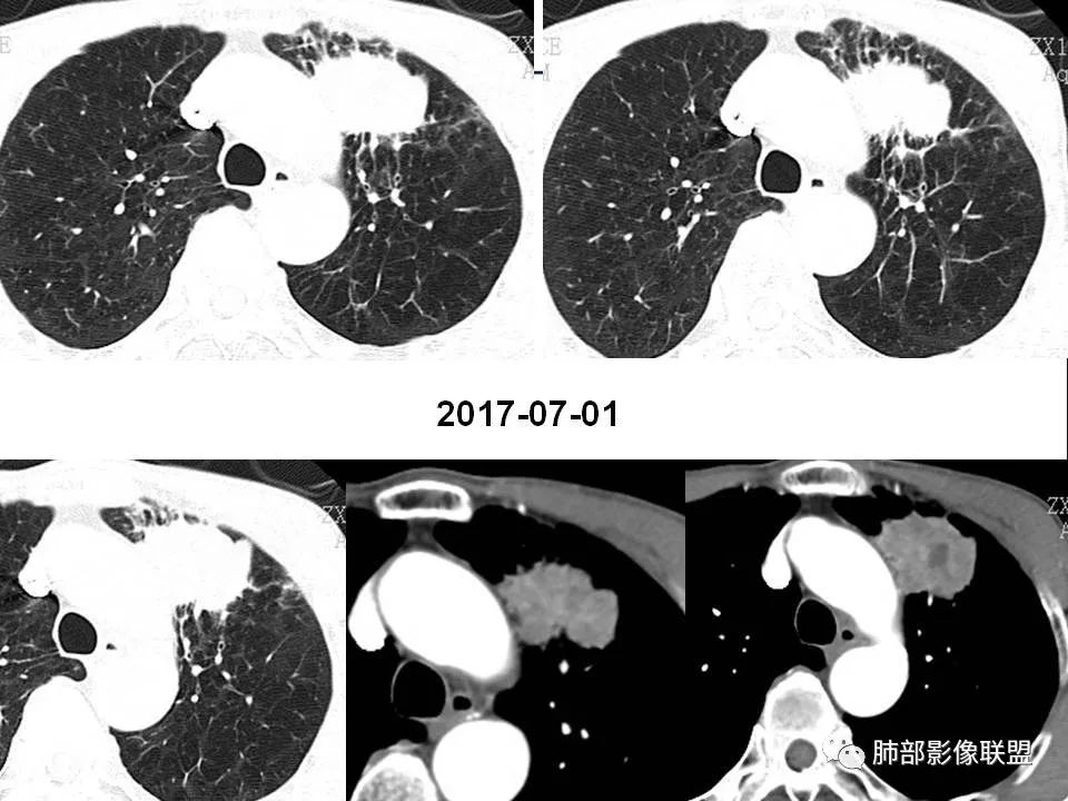 影像PPT - 【PPT】早期肺鳞癌----容易忽视的影像学表现-51