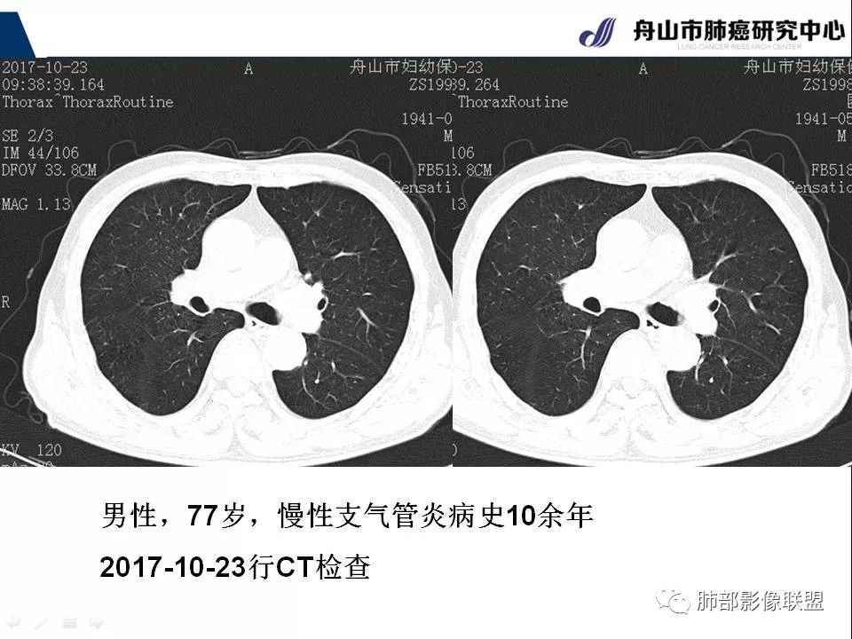 影像PPT - 【PPT】早期肺鳞癌----容易忽视的影像学表现-47