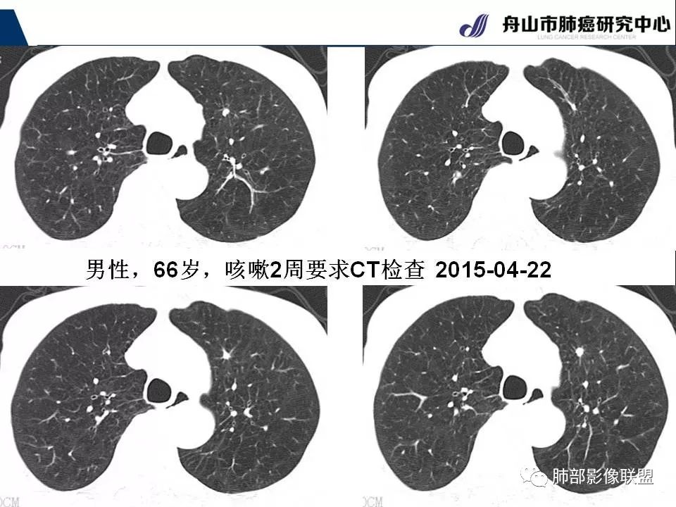 影像PPT - 【PPT】早期肺鳞癌----容易忽视的影像学表现-50