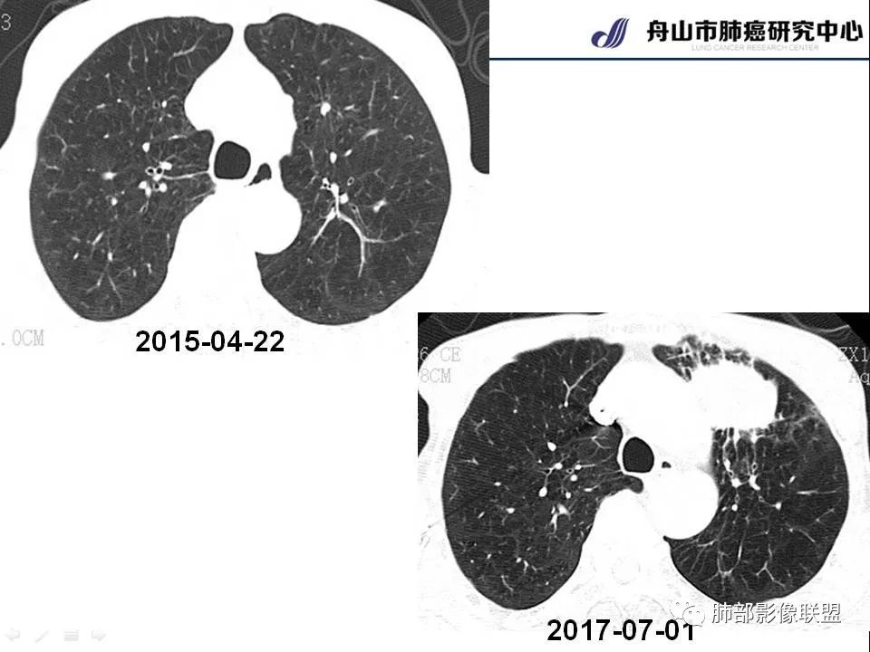 影像PPT - 【PPT】早期肺鳞癌----容易忽视的影像学表现-52