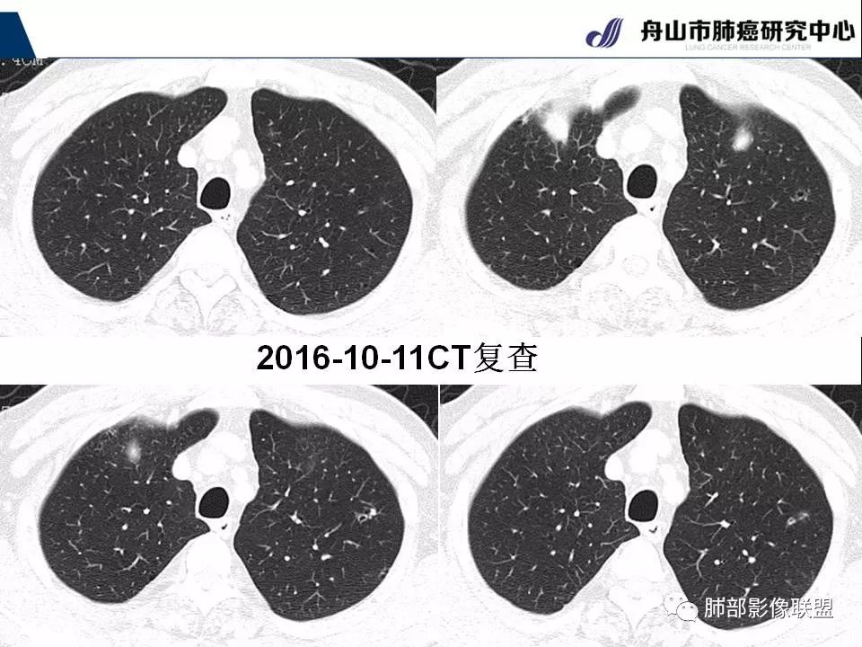 影像PPT - 【PPT】早期肺鳞癌----容易忽视的影像学表现-54