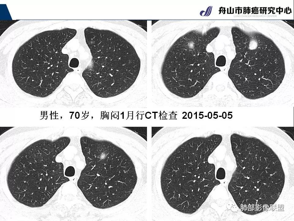 影像PPT - 【PPT】早期肺鳞癌----容易忽视的影像学表现-53