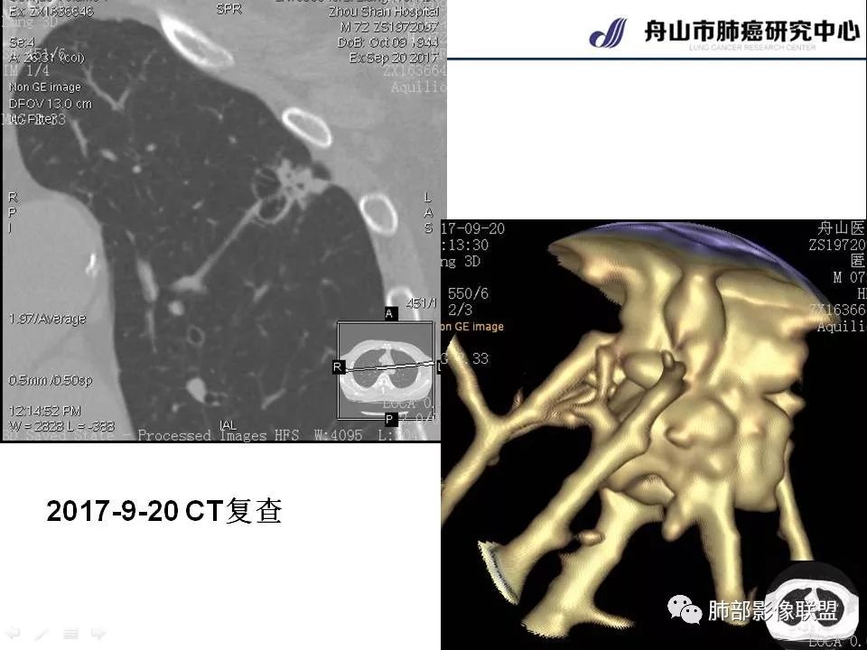 影像PPT - 【PPT】早期肺鳞癌----容易忽视的影像学表现-56