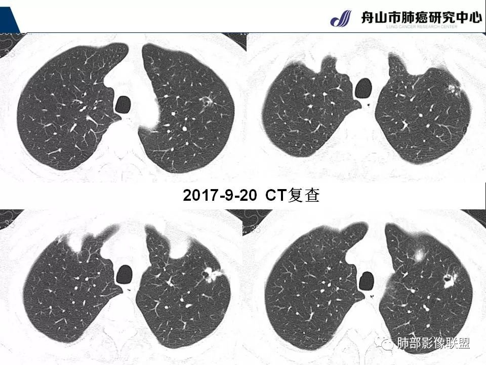影像PPT - 【PPT】早期肺鳞癌----容易忽视的影像学表现-55