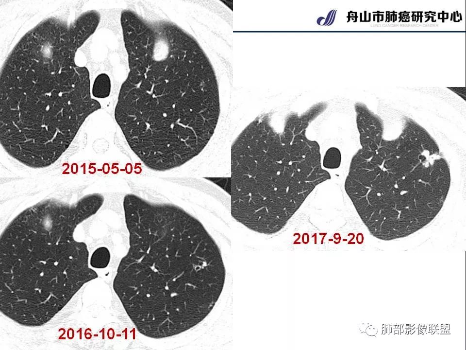影像PPT - 【PPT】早期肺鳞癌----容易忽视的影像学表现-57