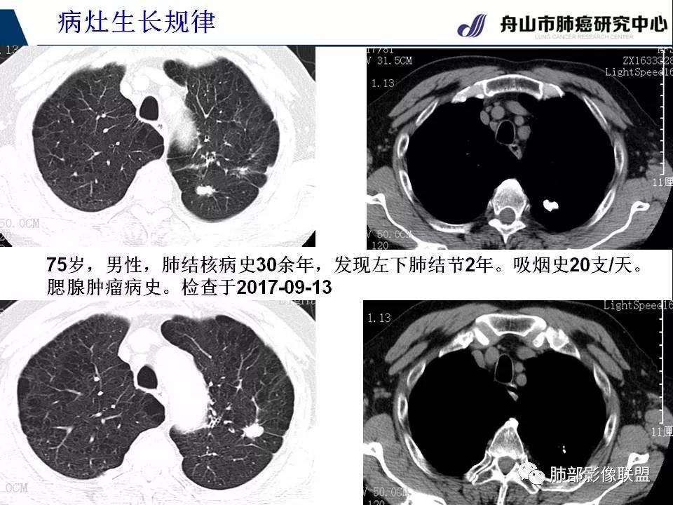 影像PPT - 【PPT】早期肺鳞癌----容易忽视的影像学表现-64