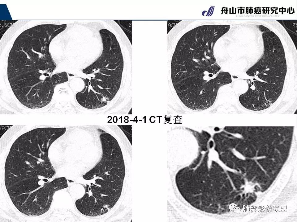 影像PPT - 【PPT】早期肺鳞癌----容易忽视的影像学表现-66
