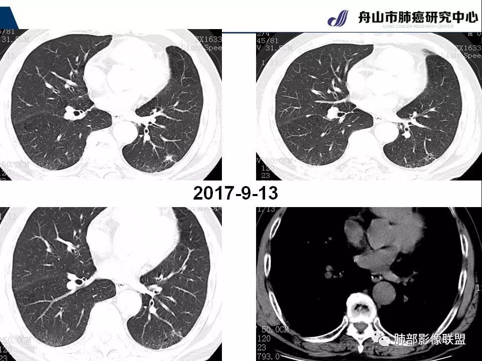 影像PPT - 【PPT】早期肺鳞癌----容易忽视的影像学表现-65